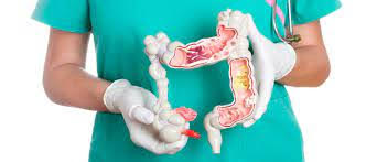 MEXICANOS ENTRE LOS QUE MÁS PADECEN CÁNCER COLORRECTAL