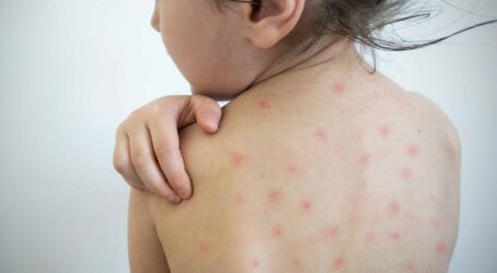 +Nueva crisis sanitaria. Es sarampión, la epidemia que debió evitarse si López Obrador no hubiera desviado el recurso de las vacunas en sus obras faraónicas; Privilegios en prisión. El poder del dinero